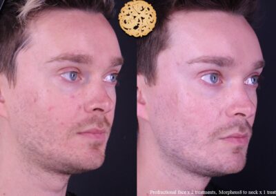 Man's before and after results from Profractional and Morpheus8 microneedling treatments on face and neck.