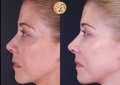 Side profile before and after microneedling on woman.