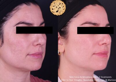 Side view of microneedling treatment progress on a woman's face, branded by SPA26.