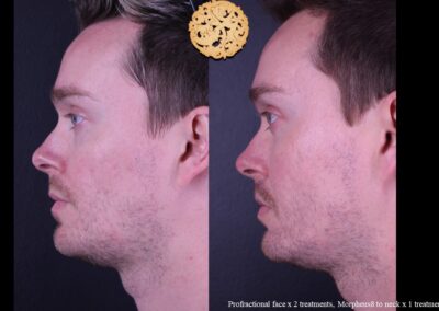 Side profile of a male before and after Profractional and Morpheus8 microneedling treatments.