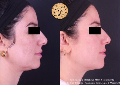 Side profile before and after SPA26 microneedling treatment showcasing facial enhancements.