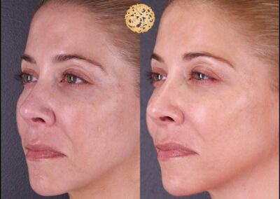 Woman's side view showing skin texture improvement after microneedling treatment compared to before.