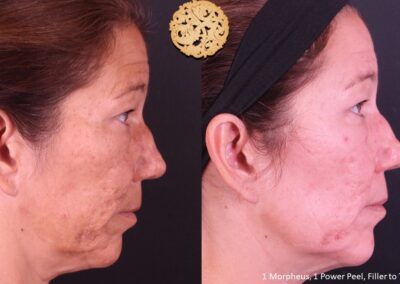 Side view of a mature woman's skin rejuvenation from microneedling with SPA26.