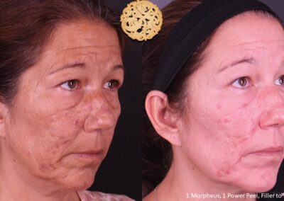 Side view after microneedling treatment showing a mature woman's enhanced skin texture by SPA26.