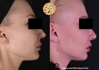 Side view post-treatment results of Vivace microneedling and microlaser peel on a woman by SPA26.