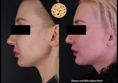 Three-quarter view of a woman's skin improvement after Vivace microneedling and microlaser peel by SPA26.