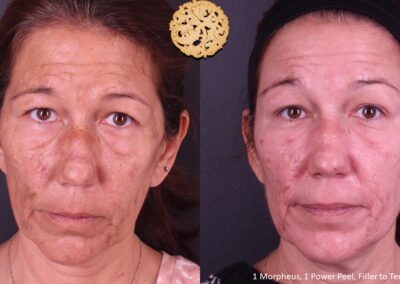 Frontal face comparison of a mature woman before and after SPA26 microneedling treatment.