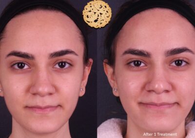 Front view of a young woman's face before and after one microneedling session, depicting clearer skin texture, with SPA26.