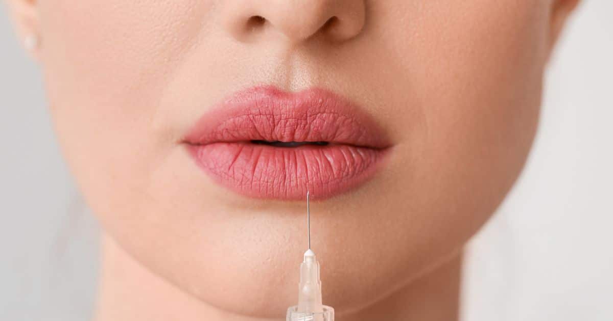 Who Is a Good Candidate for Half Syringe Lip Filler?